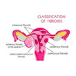 © Kristina - Fibroids, great design for any purposes. Cartoon flat vector illustration. Isolated vector.