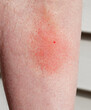 Wasp sting and surrounding irritation on shin