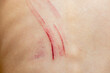 © vitalis83 - Wounds scratches on the back of a small child close up