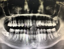 X-ray Photograph Of Teeth Of Human