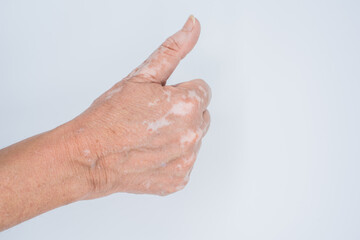 Wall Mural - Hand with vitiligo disorder with thumb up as a sign of acceptance and victory on white background