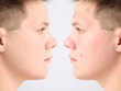© Pixel-Shot - Teenage boy before and after acne treatment on light background