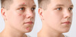 © Pixel-Shot - Teenage boy before and after acne treatment on light background