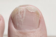 Brittle toenail causing nail surface layers or lamella to peel away with some parts splitting or broken off. Grooves and ridges on cracked nail plate due to onychorrhexis or brittle nail syndrome.