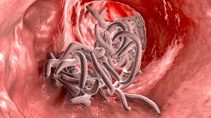 Poster - Parasitic worms in the lumen of intestine