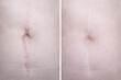 Hypertrophic keloid scar on woman stomach before and after laser treatment, removal, heal and recovery after accident or damage, cosmetology and pastic surgery solution