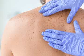 Dermatologist examining patient in clinic, closeup