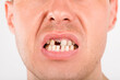 © Eskymaks - Close up of young man with missing teeth. Health care.