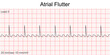 Electrocardiogram show Atrial flutter pattern. Cardiac fibrillation. Heart beat. CPR. ECG. EKG. Vital sign. Life support. Defib. Emergency. Medical healthcare symbol.