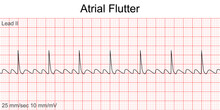 Electrocardiogram Show Atrial Flutter Pattern. Cardiac Fibrillation. Heart Beat. CPR. ECG. EKG. Vital Sign. Life Support. Defib. Emergency. Medical Healthcare Symbol.
