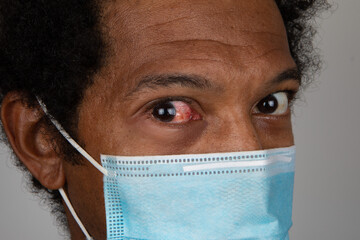 Portrait of African man showing a red eye, concept of one of the symptoms of covid 19