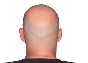 Rear view of a bald head. Adult with alopecia or hair loss. Adult man head view isolated on white background