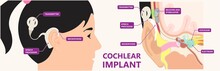 Cochlear Implant Device Electrically Stimulates Nerve Medical Aid Ear Sound Wave Adults Hard Middle Exam