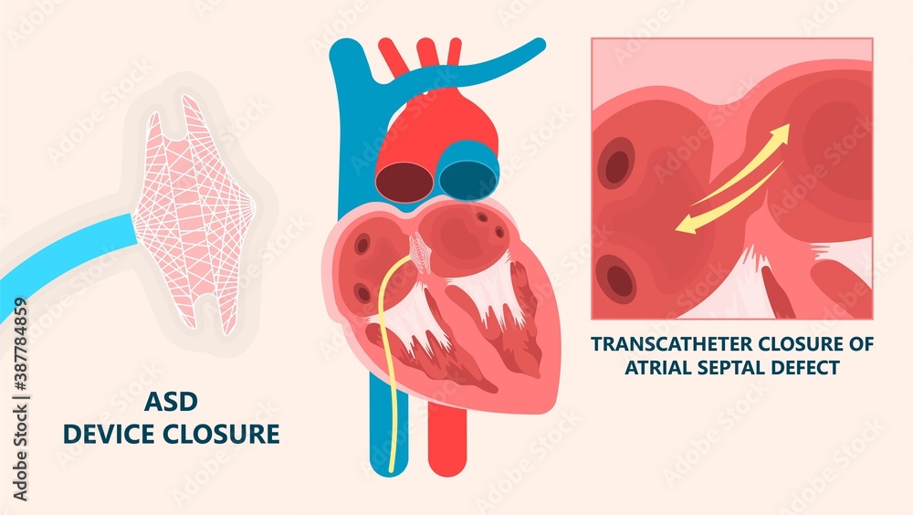 Cath Lab Atrial Septal Defect Tetralogy of Fallot Patent Foramen Ovale ...