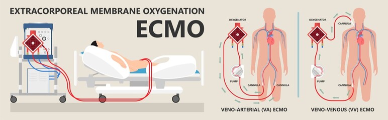 Wall Mural - Extracorporeal membrane oxygenation ECMO a life support system for Respiratory failure patient system illness damage Infection perfusionist Ards transplant myocarditis embolism