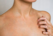 © evelinphoto - Psoriasis skin disease is a dermatic problem, red allergic skin rash.
