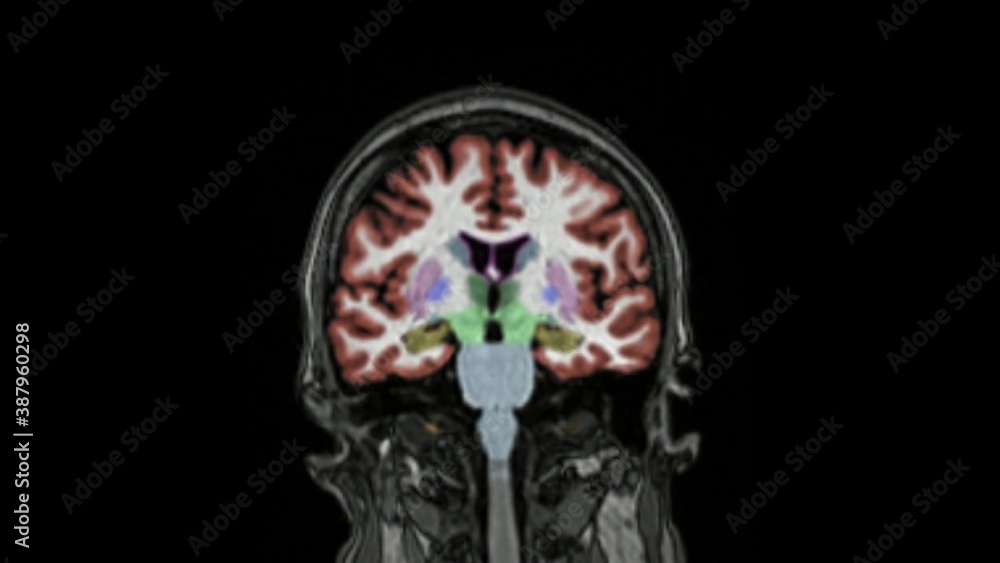 Magnetic resonance imaging of the brain in coronal plane color coded ...