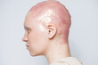 © Sergey Filimonov/Stocksy - Young hairless woman with patches on head