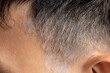 © sinhyu - Tinea circinata or ringworm on the head.
