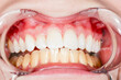 Before and after teeth bleaching or whitening treatment. Close-up of young Caucasian female's smile.