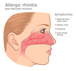 Allergic rhinitis medical diagram with inflamed turbinates. Vector infografic. 