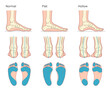 Foot deformation types medical infographic. Vector illustration.