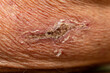Closeup of flaking scab on wrinkled skin