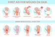 © YummyBuum - First aid for wound on skin. Damage, bleeding cut hand skin and emergency treatment procedure, therapy injury medical guide, information poster help steps vector flat infographic