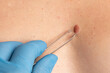 © ilyaska - Surgeon inspecting big birthmark or mole using gloves and forceps