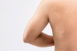 Macro white Pityriasis or Tinea Versicolor on back skin. Used for skincare concept
