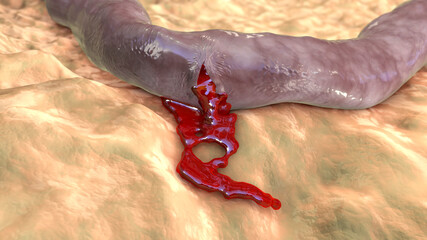 Sticker - Hemorrhage, blood flowing from the damaged blood vessel, 3D illustration