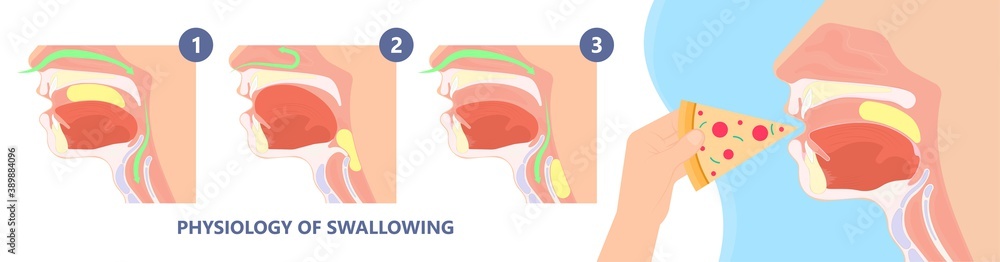 Dysphagia infection trachea examine Surgery choking gastric diagnose ...