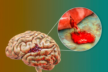 Poster - Hemorrhagic stroke, illustration