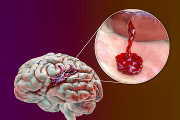 Wall Mural - Hemorrhagic stroke, illustration