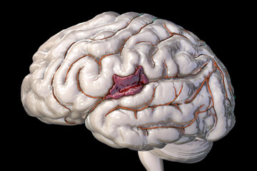 Poster - Hemorrhagic stroke, illustration