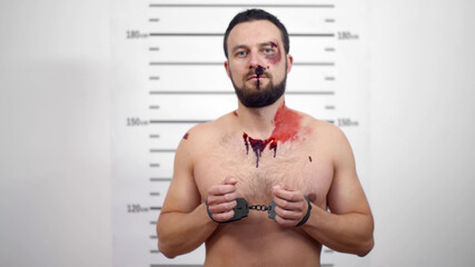 In police station arrested man with wounded face getting front-view mug shot