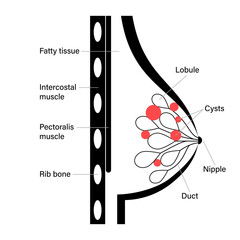 Wall Mural - Breast disease concept