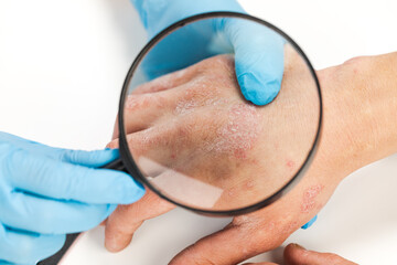 Wall Mural - A dermatologist wearing gloves examines the skin of a sick patient. Examination and diagnosis of skin diseases-allergies, psoriasis, eczema, dermatitis