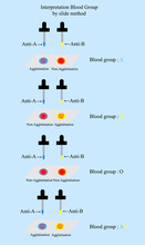 Interpretation Blood Group In ABO System By Slide Method In Laboratory