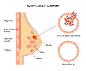 Sticker - Breast disease concept