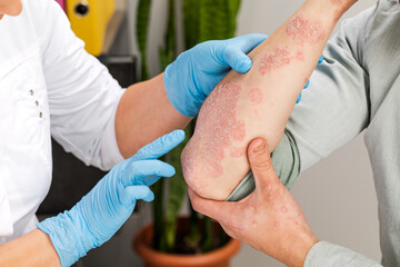 A dermatologist wearing gloves examines the skin of a sick patient. Examination and diagnosis of skin diseases-allergies, psoriasis, eczema, dermatitis