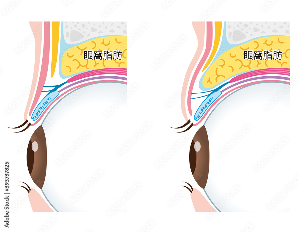 Illustration Stock 腫れぼったいまぶた 瞼の構造 | Adobe Stock