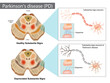 Parkinson s disease PD . Normal and Depreciated Substantia Nigra
