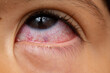 Red eye of a little girt, conjunctivitis eye
