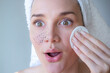 © Angelina - Woman removes blackheads with cleansing lotion