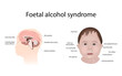 Illustration showing the effects of foetal alcohol syndrome on the brain and on a child's face. With explanations.