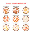 Sexually transmitted infection. Close-up of causative agents of Venereal disease