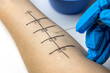 allergist doing skin prick allergy test on a patient arm closeup