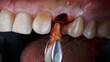 creative photo of tooth extraction with root before implantation