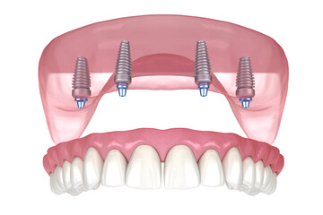 Wall Mural - Maxillary prosthesis with gum All on 4 system supported by implants. Medically accurate 3D illustration of human teeth and dentures